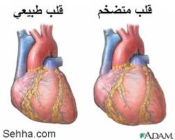 مرضى القلب وقسطرة القلب