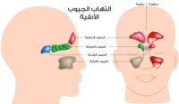 انتفاخ الجيوب الانفية 20161013 2560