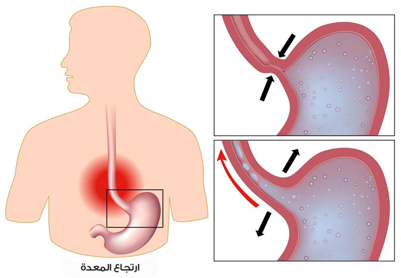 علاج الارتجاع المريئي 20161011 413