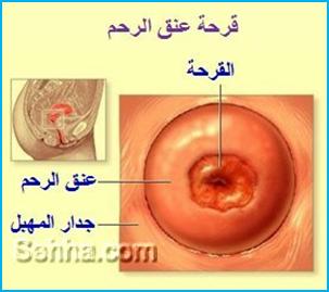 التهابات المهبل عند الاطفال 20161007 1593