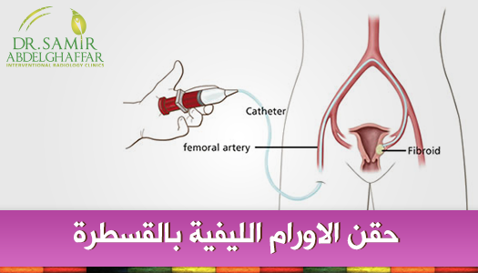 هل يوجد في الجزائر علاج للاورام الليفية بالقسطرة 20161013 223