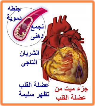 تصلب شرايين الدماغ 20161007 1077