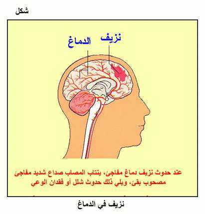 ما هو نزيف الدماغ 20161004 1135