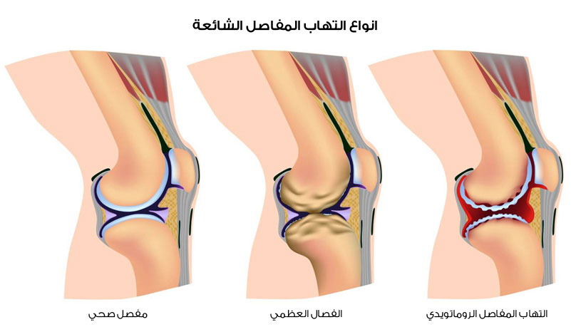 علاج التهاب العضلات والاعصاب بالاعشاب 20160826 180