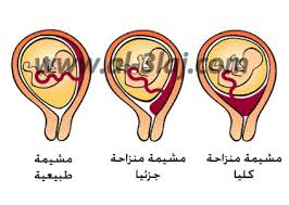 اسباب نزول المشيمه وعلاجها 20161005 136