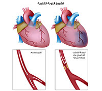 الذبحة الصدرية الاسباب والعلاج