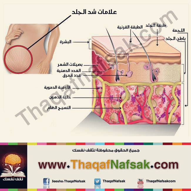 علاج الخطوط البيضاء في البشرة