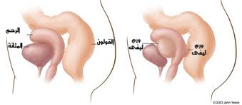 المناظير وعلاج التليفات