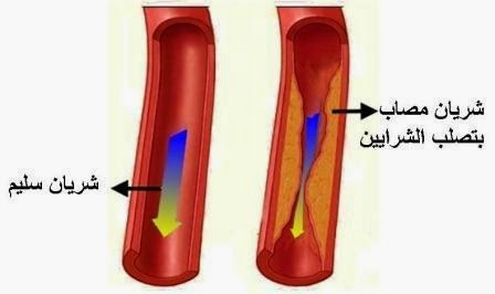 كيف تعالج انسداد الشرايين 20161015 915