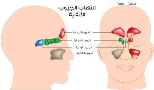 علاج تحسس الجيوب الانفية