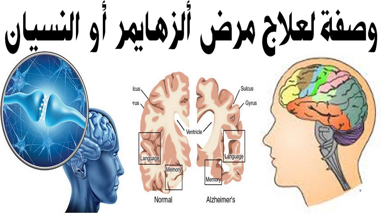 علاج مرض الزهايمر